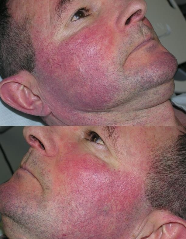 Rosacea Before (2)