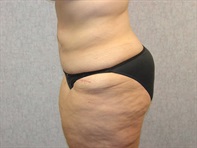 Dr. Serra Plastic Surgery Before & After